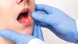 Cara Mengatasi Gusi Berdarah Secara Alami Panduan Lengkap Untuk Kesehatan Mulut Optimal