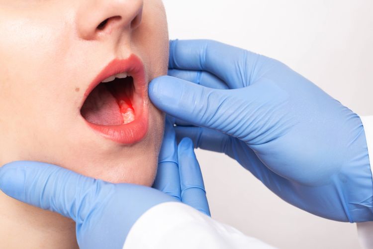 Cara Mengatasi Gusi Berdarah Secara Alami Panduan Lengkap Untuk Kesehatan Mulut Optimal